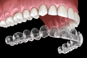 Clear Aligner Treatment in Bakırköy Istanbul