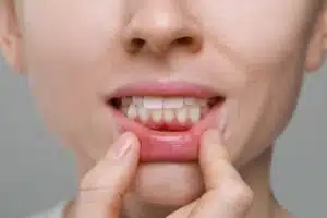 diş eti çekilmesi