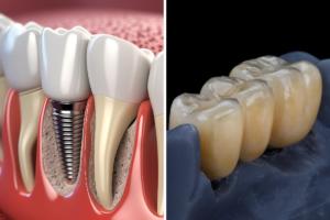 implant mı köprü mü